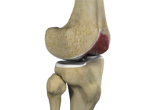 Picture of Knee Arthritis