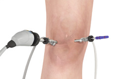 Picture of Knee Arthroscopy