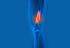 Picture of Knee Fracture