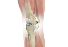 Picture of Complex Knee Injuries