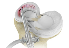 Picture of Meniscal Surgery