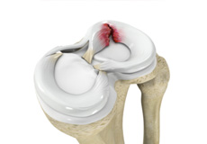 Picture of Meniscus Injury or Tear