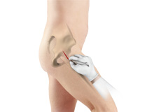 Picture of Minimally Invasive Total Hip Replacement