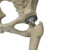 Picture of Painful Total Hip Replacement