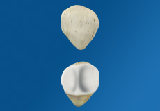 Picture of Patellar Knee Injury