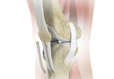 Picture of Patellar Tendon Repair