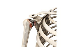 Picture of Periprosthetic Shoulder Infection