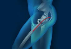 Picture of Posterior Total Hip Replacement