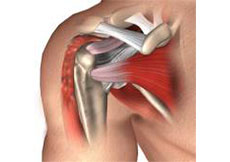 Picture of Proximal Biceps Tenodesis