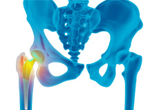Picture of Revision Total Hip Replacement