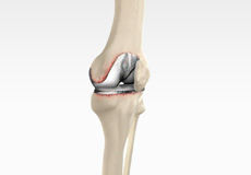 Picture of Revision Knee Replacement