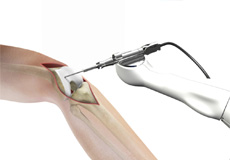 Picture of Robotic Assisted Knee Replacement