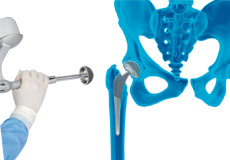 Picture of Robotic Assisted Total Hip Replacement