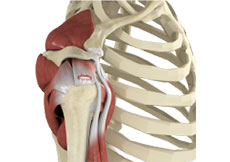 Picture of Rotator Cuff Injury or Tear