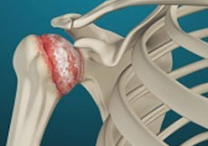 Picture of Arthritis of the Shoulder