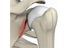 Picture of Shoulder Fracture