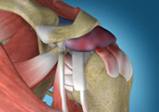 Picture of Other Shoulder Tendon Injuries