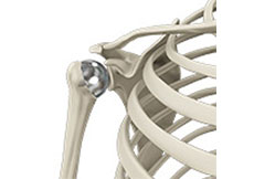 Picture of Shoulder Resurfacing