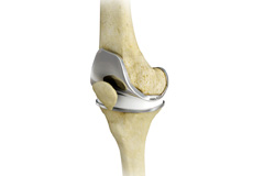 Picture of Total Knee Replacement