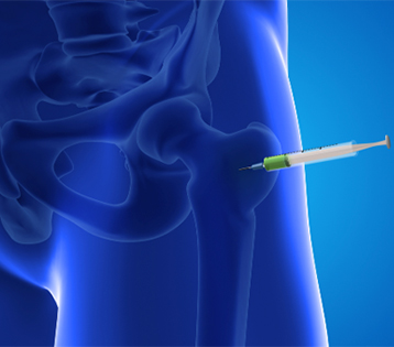 A Few Millimeters Matter: Why Image-Guided Hip Injections Can Significantly Affect Accuracy and Outcomes