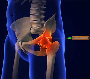 Targeting the Source: Why Ultrasound-Guided Precision Matters in Hip Injections