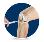 Viscosupplementation