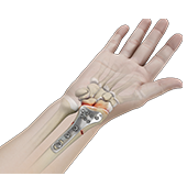 ORIF of Distal Radius Fracture