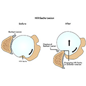 Hill-Sachs Lesion