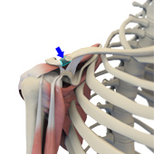 Mumford Distal Clavicle Excision