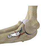 ORIF of the Coronoid Fractures