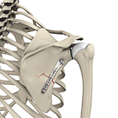ORIF of the Scapula Fractures