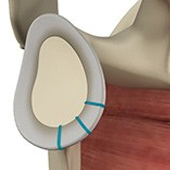 Shoulder Labrum Reconstruction