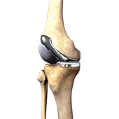 Custom-fitted Total Knee Arthroplasty