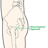 Direct Superior Hip Replacement