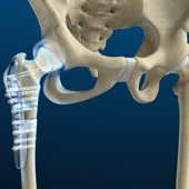 Hip Fracture ORIF