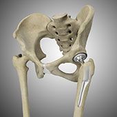 Total Hip Replacement