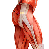Mini-Posterior Hip Replacement