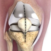 Minimally Invasive Knee Joint Replacement