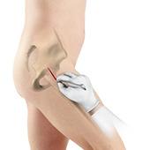 Minimally Invasive Total Hip Replacement