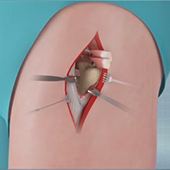 Outpatient Anterior Approach Hip Replacement