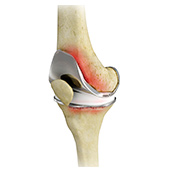Painful or Failed Total Knee Replacement