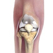 Patient Specific Knee Replacement