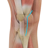 Picture of Quadriceps-Sparing Subvastus Knee Replacement