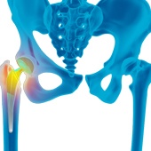 Revision Hip Replacement