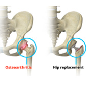 Short-Stay and Fast-Track Hip Replacement