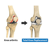 Short-Stay and Fast-Track Knee Replacement