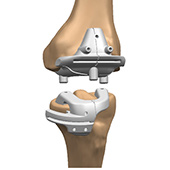 Visionaire Knee Replacement