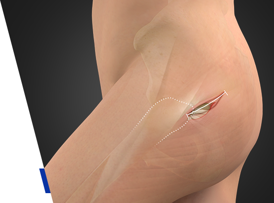 Chris Hoedt, MD - Orthopaedic Surgeon - Hip & Knee Reconstruction Specialist