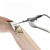 Picture of Robotic Total Hip Replacement