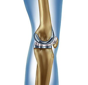 Rapid recovery joint replacement anatomy